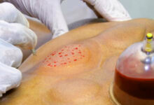 شروط الحجامة للنساء