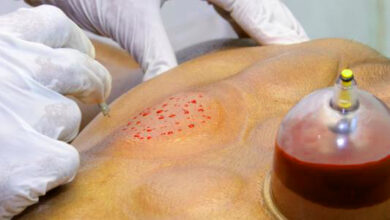 شروط الحجامة للنساء