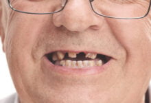 البحث الياباني: صحة الأسنان ترتبط بمخاطر الخرف والشيخوخة المبكرة