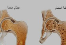 ما هي علاقة هشاشة العظام بانقطاع الطمث؟