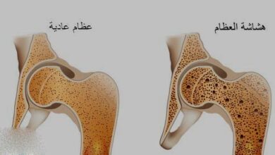 ما هي علاقة هشاشة العظام بانقطاع الطمث؟