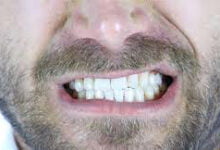 ما ‫أسباب صرير الأسنان؟