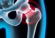 ‫‫أعراض كسر عنق الفخذ