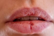 أسباب تشقق الشفاه