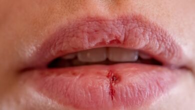 أسباب تشقق الشفاه