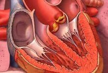 ‫هذه أعراض التهاب الشغاف