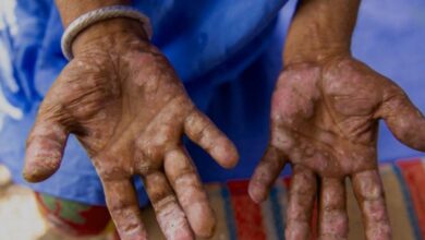 مرض الجذام لا يزال يهدد البشرية