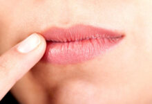 تشقق زوايا الفم قد ينجم عن أسباب خطيرة