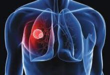 ‫الوذمة الرئوية الأسباب والأعراض