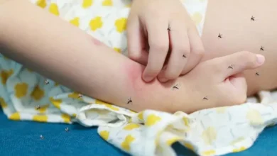 ‫حمى الضنك الأعراض وسبل الوقاية