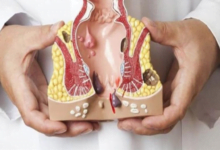 عوامل ترفع خطر تضخم البواسير