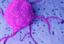 باحثون صينيون يحرزون تقدما هاما في علاج سرطان القولون