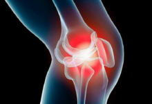 التهاب المفاصل