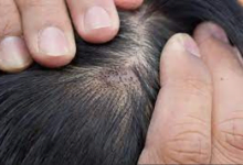 لماذا تظهر بثور في فروة الرأس؟