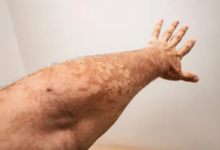 ما هي النخالية المبرقشة؟