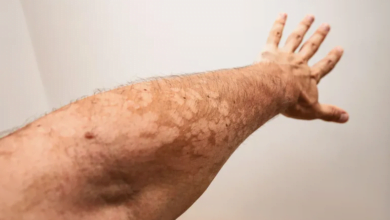 ما هي النخالية المبرقشة؟