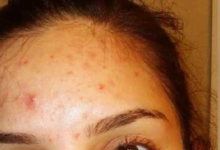 ظهور الحبوب في الجبهة