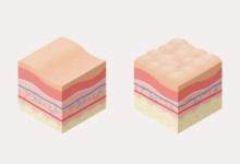 أسلحة لمحاربة السيلوليت