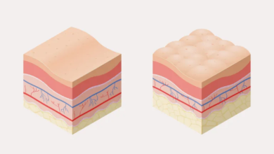 أسلحة لمحاربة السيلوليت