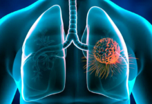 الأنظمة الغذائية قليلة الدهون تقلل خطر سرطان الرئة