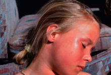 الحروق الشمسية متى تستلزم استشارة الطبيب؟