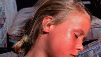 الحروق الشمسية متى تستلزم استشارة الطبيب؟