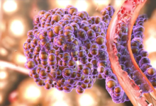 لماذا تقضي علاجات السرطان على أورام وتعجز عن أخرى؟