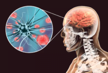 التهاب الدماغ بعد العدوى يُسبب ضعف العضلات