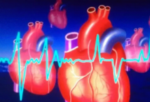 ابتكار طبي: الاستئصال بالمجال النبضي يحدث ثورة في علاج الرجفان الأذيني