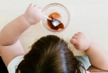 دراسة جديدة تكشف: السمنة في الطفولة تزيد من خطر الإصابة بالأمراض الجلدية المرتبطة بالجهاز المناعي