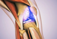 اكتشاف جديد في علاج التهاب المفاصل العظمي: الجزيئات الراقصة تعزز تجديد الغضروف