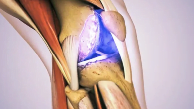 اكتشاف جديد في علاج التهاب المفاصل العظمي: الجزيئات الراقصة تعزز تجديد الغضروف