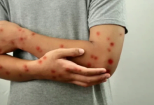 منظمة الصحة العالمية تضيف لقاحا لجدري القردة إلى قائمة التأهيل المسبق