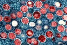 الهند تشتبه في إصابة جديدة بجدري القردة لرجل عائد من دولة تشهد تفشي الفيروس