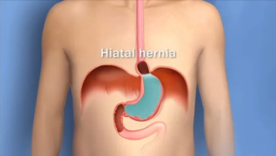 التجشؤ المستمر قد ينذر بحرقة المعدة: نصائح للوقاية والعلاج