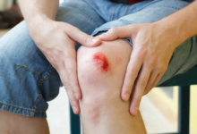 بروتين من ديدان طفيلية يعزز التئام الجروح ويمنع الندب: اكتشاف علمي جديد في جامعة روتجرز