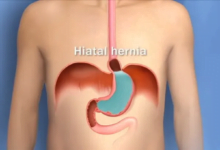 ‫التجشؤ الحامضي والمستمر ينذر بحرقة المعدة