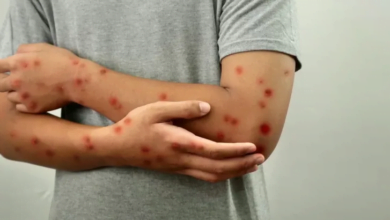 اليونيسف تطلق مناقصة طارئة لتأمين لقاحات جدري القردة بالتعاون مع منظمات دولية