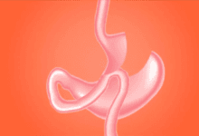 جراحة السمنة تقلل من خطر تقدم مرض الكلى المزمن لدى مرضى السكري والسمنة