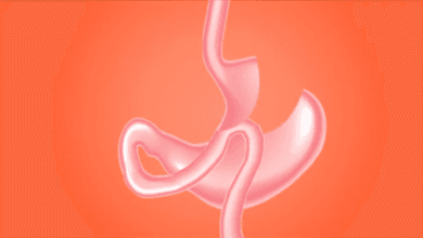 جراحة السمنة تقلل من خطر تقدم مرض الكلى المزمن لدى مرضى السكري والسمنة