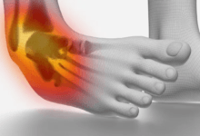 إصابات الكاحل: الأسباب، العلاج، وطرق الوقاية