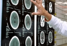 اكتشاف علمي جديد يفتح آفاقًا واعدة لعلاج الورم الأرومي الدبقي