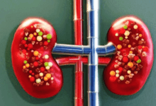 مرض السكري الكاذب الكلوي: الأسباب، الأعراض، وسبل العلاج