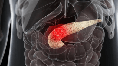 سرطان البنكرياس بين الشباب: زيادة في الحالات وتطورات جديدة في التشخيص والعلاج