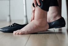 أسباب تشنجات عضلات الساق وطرق الوقاية والعلاج